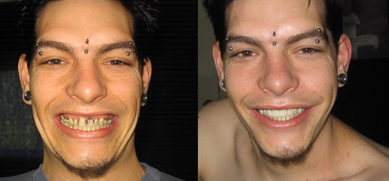 From "meth mouth" to "fuck yeah mouth" in just 6 mouth-deadening hours